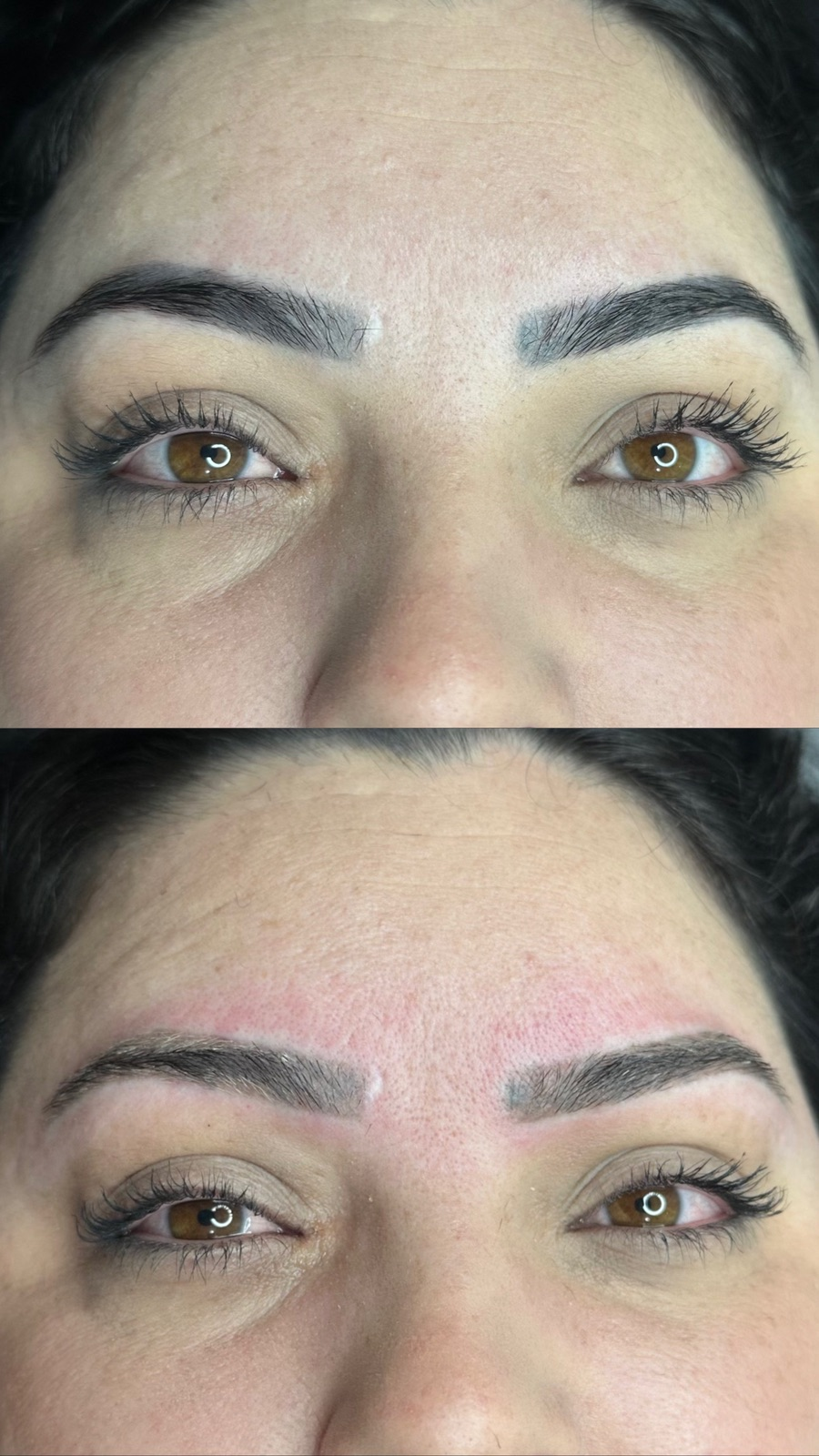 Registro real de remoção a laser: Avaliação real