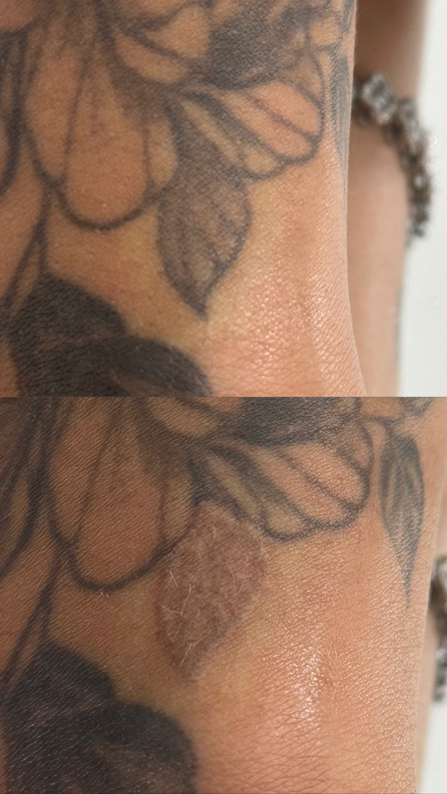 Registro real de remoção a laser: Tatuagem