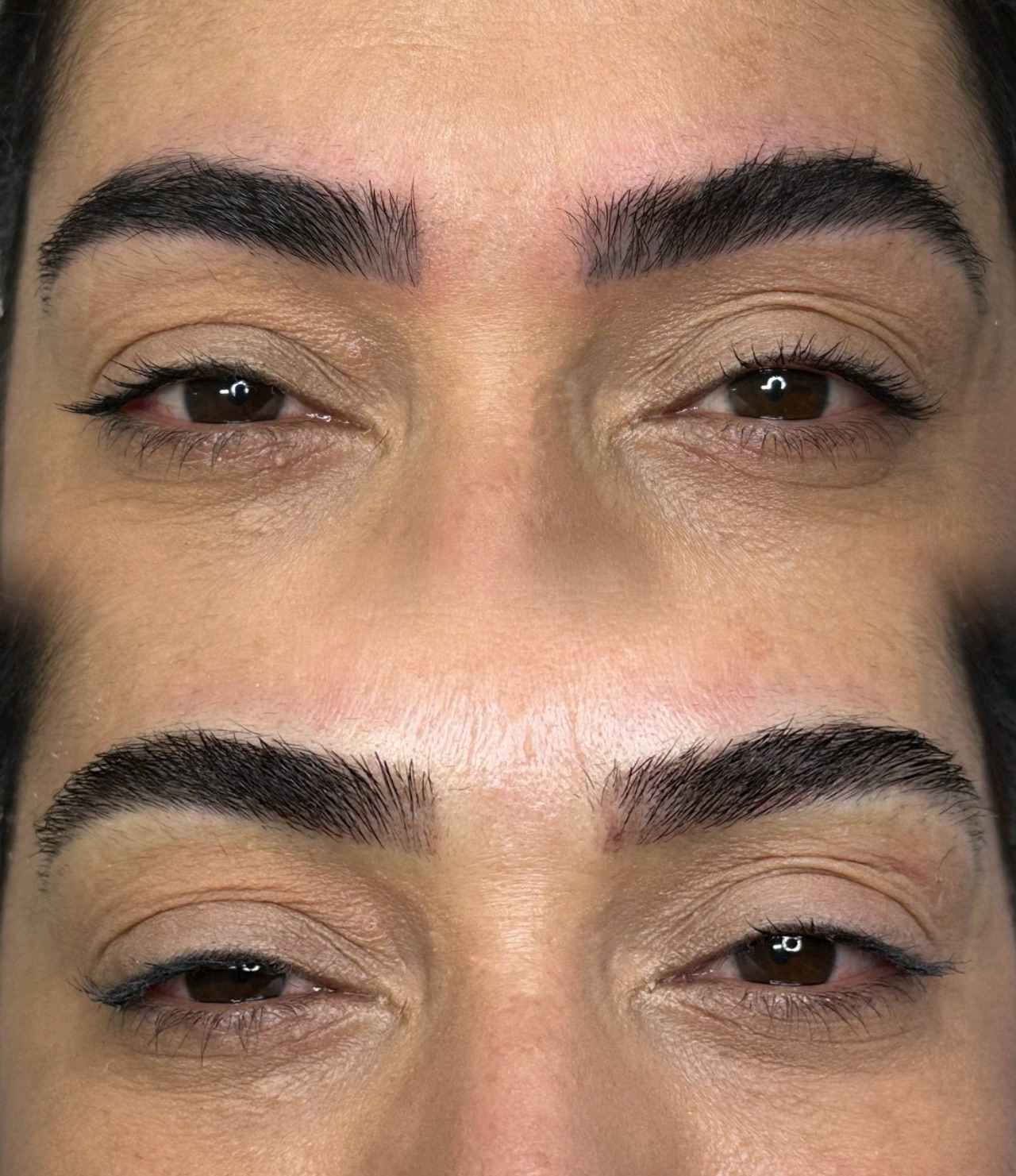 Remoção a Laser realizado por Daniela Moura